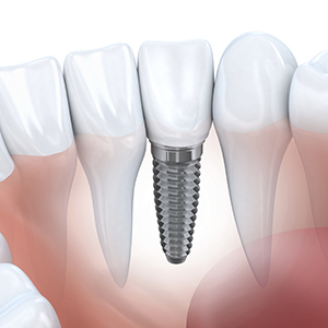A digital image of a single tooth dental implant in Arlington