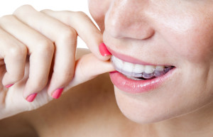 Woman placing Invisalign tray onto teeth