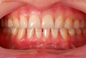 Healthy gums.