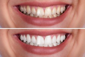 before-and-after teeth whitening