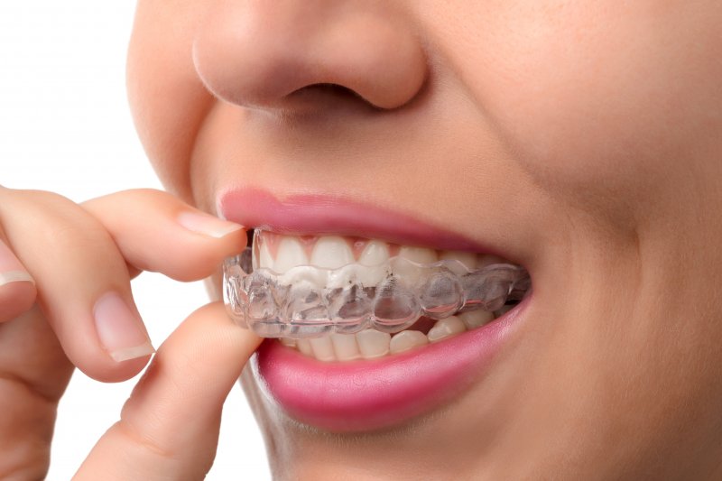 a woman inserting an Invisalign aligner over her top row of teeth