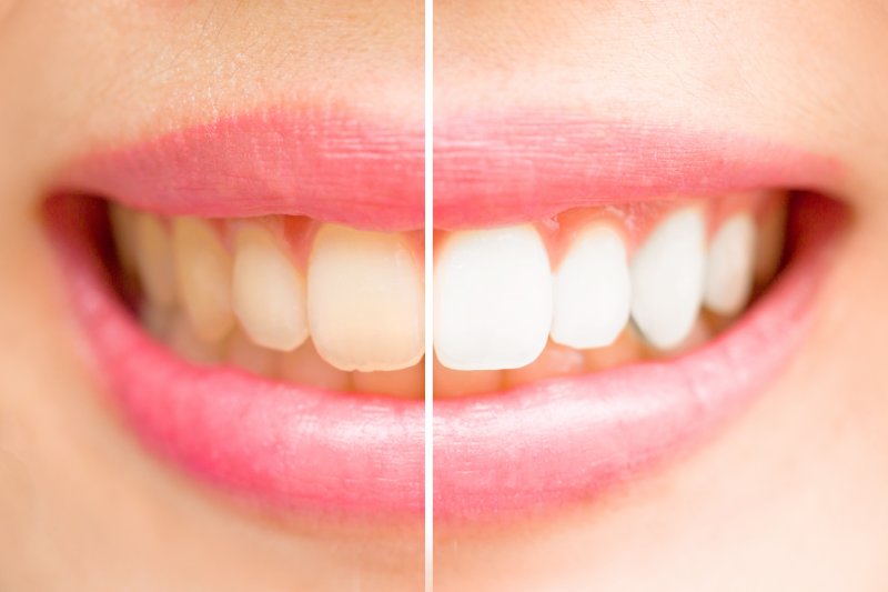 A before and after image of a person’s smile after teeth whitening in Arlington