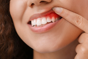 Close-up of a person pulling up lip to show inflamed gums