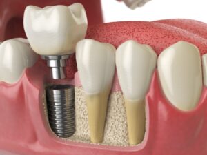 Animated model of dental implant.